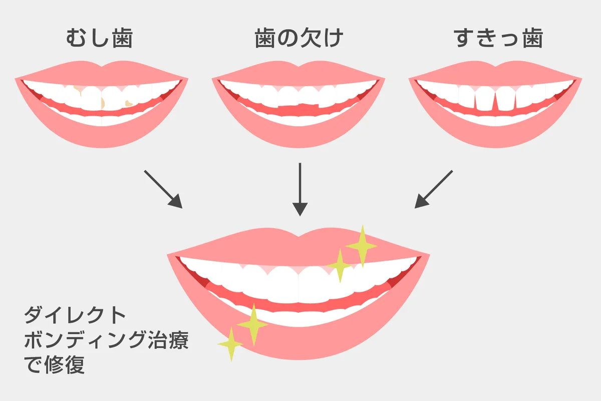 ダイレクトボンディング