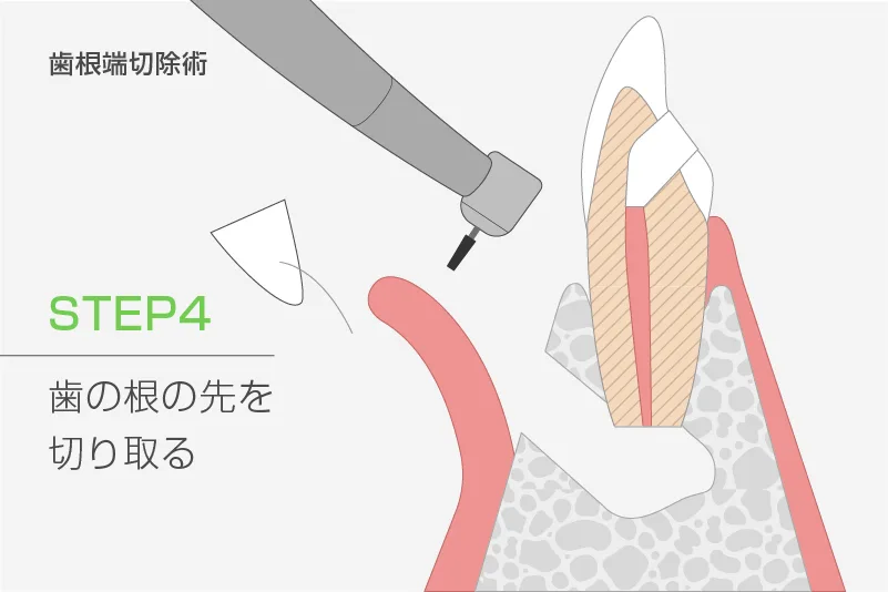 歯根端切除術