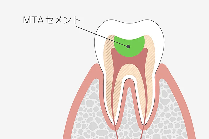 MTAセメント
