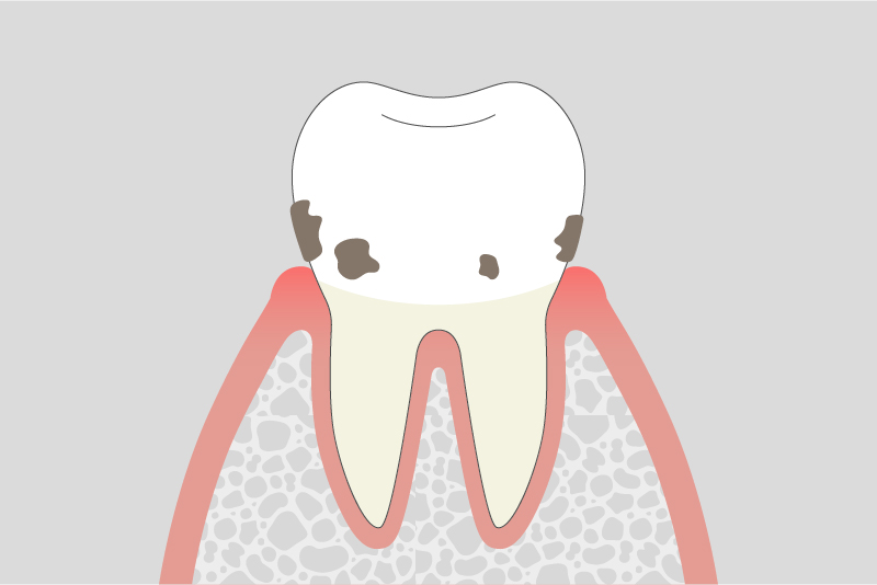 軽度歯周炎